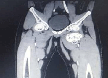 3D CT Scan