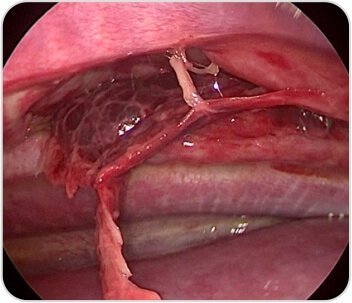 7th & 8th Rib intercostal muscle tear with hematoma and lung herniation