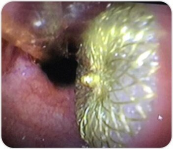 ASD closure device inner flange deployed in Esophagus