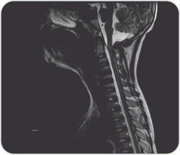 Acute Onset Quadriplegia As A Complication Of Hepatitis