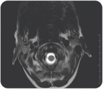 Acute Onset Quadriplegia As A Complication Of Hepatitis