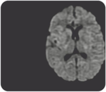 Acute Onset Quadriplegia As A Complication Of Hepatitis