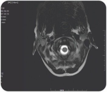 Acute Onset Quadriplegia As A Complication Of Hepatitis