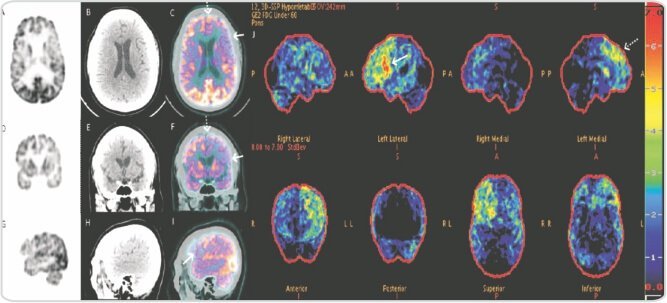 A Case of Agrammatic/Non-Fluent Variant of Primary Progressive Aphasia (Broca's Aphasia)