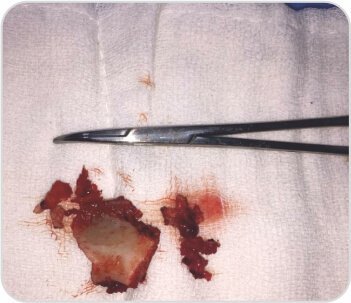 Case of Arterial Thoracic Outlet Syndrome