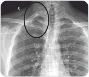 Case of Arterial Thoracic Outlet Syndrome