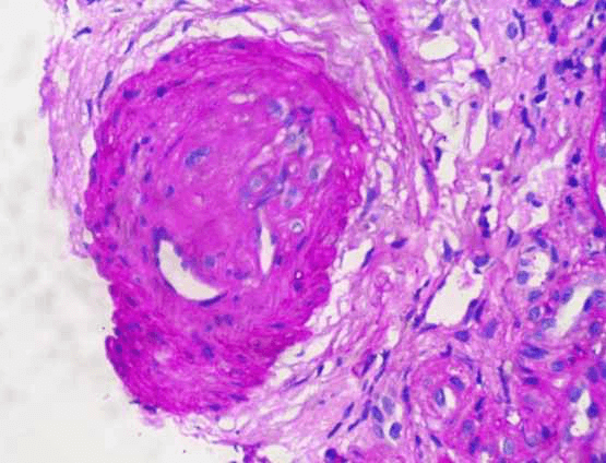 Artery with luminal occlusion due to a thrombus displaying partial recanalization (PAS, 40X)