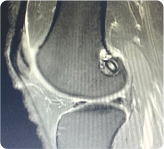 Arthroscopic Revision ACL (Anterior Cruciate Ligament) Reconstruction