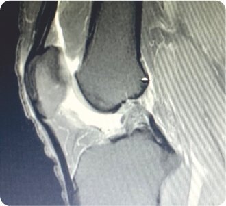 Arthroscopic Revision ACL (Anterior Cruciate Ligament) Reconstruction