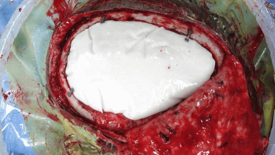 3d printing technology in Neurosurgery