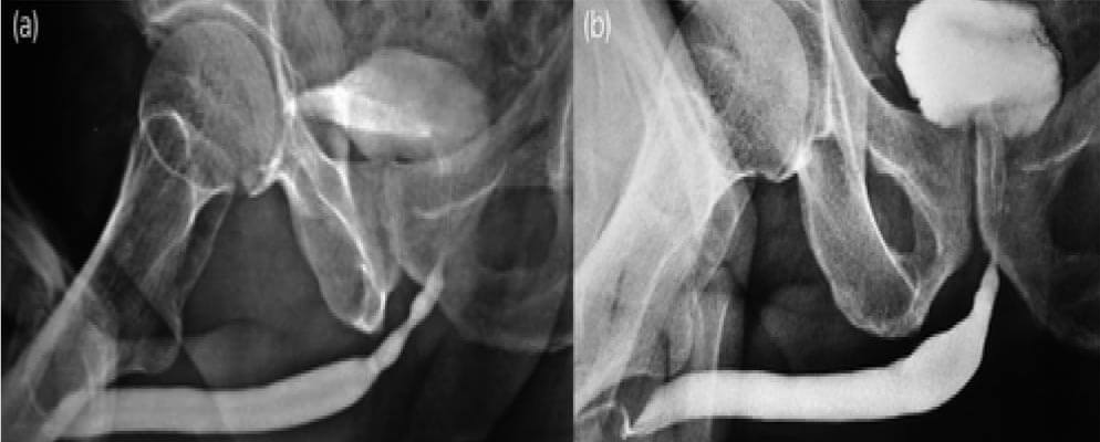 BEES-HAUS procedure Urethrogram