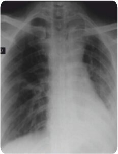 Balloon Bronchoplasty of Tubercular Stenosis