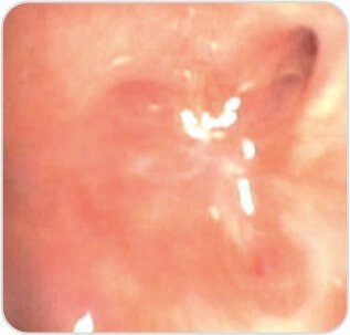 Balloon Bronchoplasty of Tubercular Stenosis