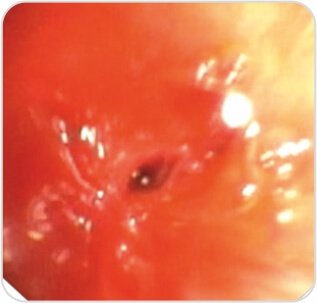 Balloon Bronchoplasty of Tubercular Stenosis