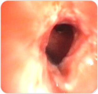 Balloon Bronchoplasty of Tubercular Stenosis