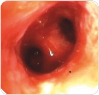 Balloon Bronchoplasty of Tubercular Stenosis