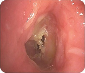 Balloon Dilatation of Tracheal Stenosis