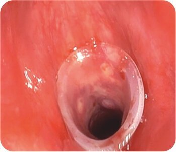 Balloon Dilatation of Tracheal Stenosis