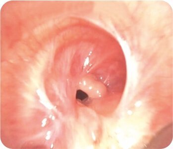 Balloon Dilatation of Tracheal Stenosis