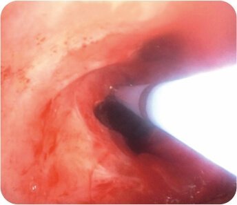 Balloon Dilatation of Tracheal Stenosis