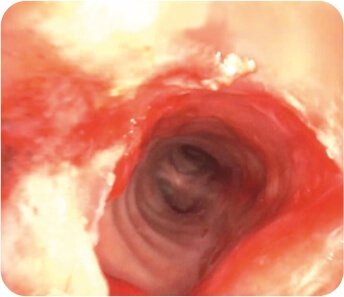 Balloon Dilatation of Tracheal Stenosis