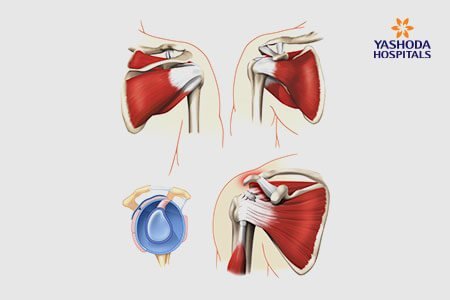 Symptoms and Risk Factors of Biceps Tendon Injuries