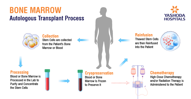 Bone Marrow Transplant (BMT)_Body 4