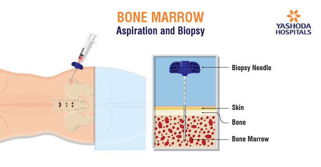 Bone Marrow Transplant (BMT)_Body 6