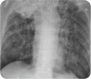 Bronchial Artery Embolisation and Sphigot Insertion of Bronchus