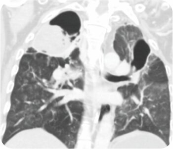 Bronchial Artery Embolisation and Sphigot Insertion of Bronchus