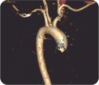 Bronchial Artery Embolisation and Sphigot Insertion of Bronchus