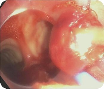 Bronchial Artery Embolisation and Sphigot Insertion of Bronchus