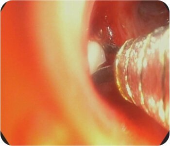 Bronchial Artery Embolisation and Sphigot Insertion of Bronchus