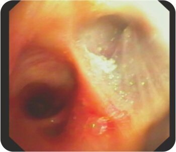 Bronchial Artery Embolisation and Sphigot Insertion of Bronchus