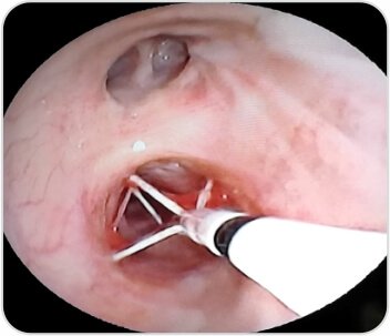 Bronchial Thermoplasty case-study