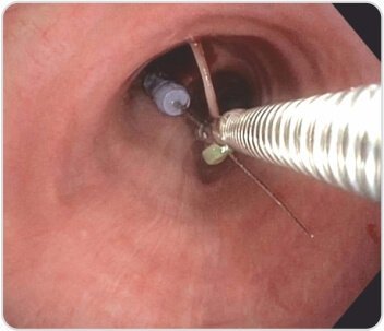 Bronchoscopic Removal of Foreign Body