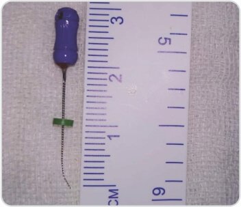 Bronchoscopic Removal of Foreign Body