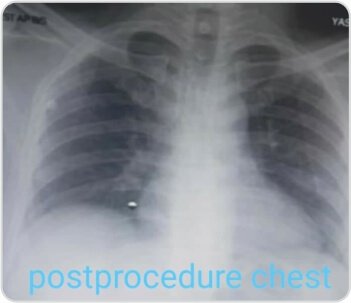 Bronchoscopic Removal of Foreign Body