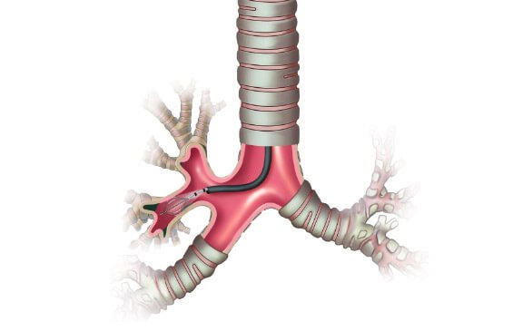 Bronchoscopy Cost in India | Bronchoscopy Cost in Hyderabad