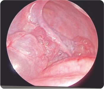 Bullous Lung Disease with Spontaneous Right Sided Pneumothorax