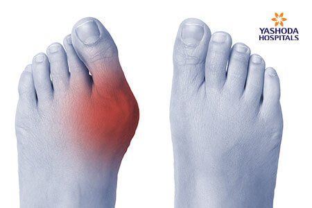 Bunions: Symptoms, Risk Factors and Complications