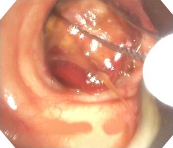 Electrocautery Snare