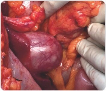 Extended Cholecystectomy with CBD Excision for Squamous Cell Carcinoma of Gall Bladder