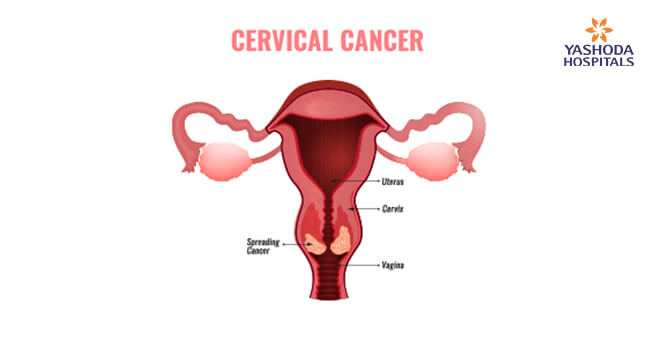 Cervical Cancer