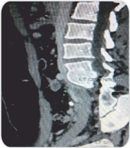 A Challenging Case of Left Leg DVT in A Young Girl