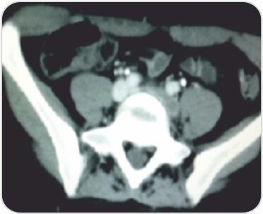 A Challenging Case of Left Leg DVT in A Young Girl