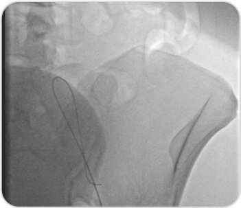 A Challenging Case of Left Leg DVT in A Young Girl