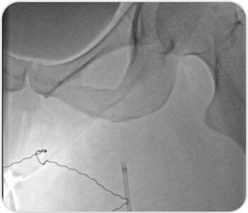 A Challenging Case of Left Leg DVT in A Young Girl