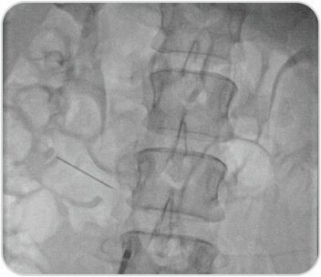 A Challenging Case of Left Leg DVT in A Young Girl