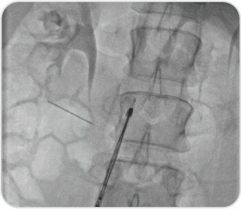 A Challenging Case of Left Leg DVT in A Young Girl